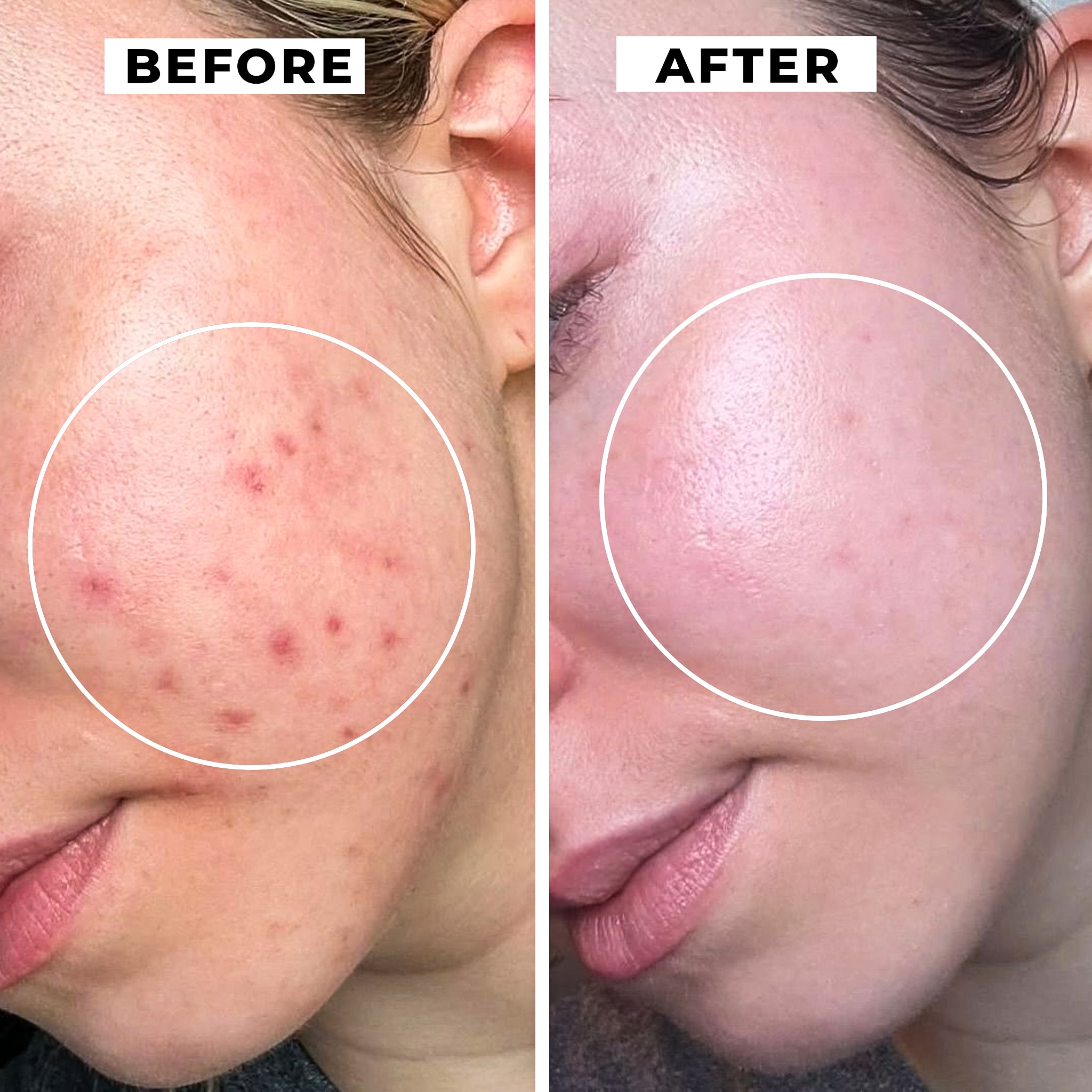 Free Sample 1 per Customer: Decimal Azelaic Acid 20% Skin Brightening Cream - 5ml Trial Size